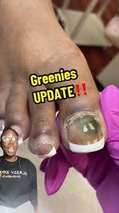Image result for Onycholysis feet