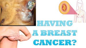 How do i know if i have breast cancer? Breast Cancer How To Know If You Have Breast Cancer Youtube