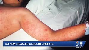 6 fully vaccinated people in South Carolina have gotten the measles