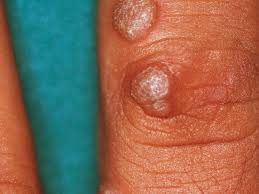 Image result for verrucae filiformes
