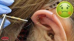Ear piercings are prone to infection, especially when they are new. Is Her Ear Piercing Infected Youtube