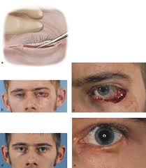 Image result for Eyelid Closure Defect