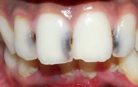 Before filling the tooth, the dentist will make sure that the tooth preparation is smooth and there are no rough and sharp edges. Dental Filling And Tooth Cavity Filling Cost Treatment Causes