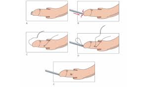 Image result for Urethral Prolapse
