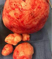 Maybe you would like to learn more about one of these? Fertility Preserving Surgery To Remove Fibroid Tumors Lev Kandinov M D Obgyn