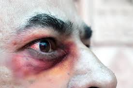 Finally, his eyelid began to droop. A Black Fungus Infection Is Killing Covid 19 Patients In India Aim