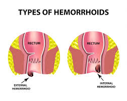 Image result for hemorrhoids