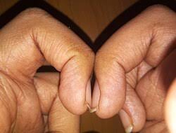 Image result for Clubbing nails feet