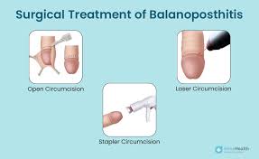 Image result for balanoposthitis