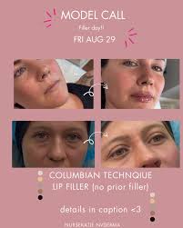 Achieving a Balanced and Defined Look with Lip Fillers 💉💋