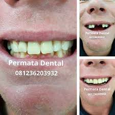 We did not find results for: Ahli Gigi Palsu Denpasar Permata Dental Pasang Gigi Palsu Lepas Pasang Akrilik Untuk Memperbaiki 2 Gigi Ompong Di Bagian Depan