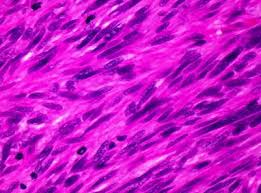 Image result for Leiomyosarcoma