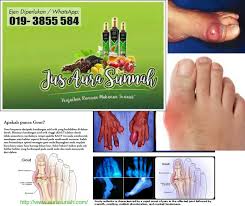 Gout adalah sejenis penyakit akibat *berlebihan asid urik* di dalam badan. Fakta Tentang Gout Yang Patut Anda Tahu