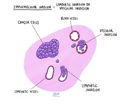 Ian sample discusses the findings of a medical study that identified genetic markers for breast, ovarian and prostate cancer. Lymphovascular Invasion Pathology Dictionary Mypathologyreport Ca