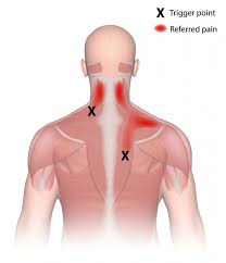 The muscles of the low back stabilize the spine, while the muscles of the hip are what moves the spine, says atkins. Trigger Point Injections For Lower Back Pain