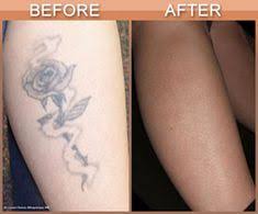 9 Before After Tattoo Removal Ideas Tattoo Removal Tattoos Laser Tattoo Removal