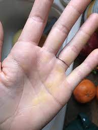 Choose from 30+ orange spot graphic resources and download in the form of png, eps, ai or psd. Yellow On Hands Like Highlighter Except It S Not Health Ketogenic Forums