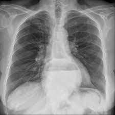 Axiale Und Paraosophageale Hiatushernie Lecturio