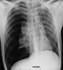 Macduff а., arnold а., harvey j. Merheim Lungenklinik Pneumothorax