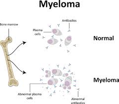 This produces diffuse bone marrow infiltration causing bone destruction and bone marrow failure. What Is Myeloma Myeloma Patients Europe
