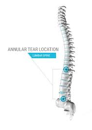 Maybe you would like to learn more about one of these? What Is An Annular Tear Annual Tear Treatment Clearwater