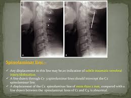 Tips of the spinous processes. Imaging Of Spinal Trauma Ppt Download