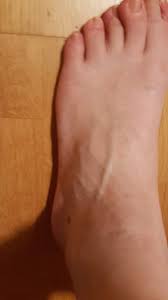 Sollte ich zum arzt gehen? Mit Fuss Umgeknickt Zum Arzt Gesundheit Unfall