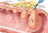 Image result for stage 5 colon cancer symptoms