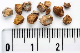 Care After An Operation For Kidney Stones Kidney Stones Kidney Stone Diet Signs Of Kidney Stones