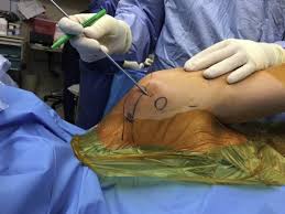 Left lateral decubitus position (lldp) would mean that the patient is lying on his or her left side. Lateral Decubitus Position For Arthroscopic Suprapectoral Biceps Tenodesis Arthroscopy Techniques