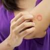 Ciclopirox shampoo is used to treat seborrheic dermatitis , an inflammatory skin condition of the scalp. 1