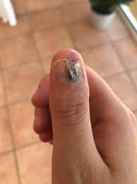 Image result for Acral lentiginous melanoma nail