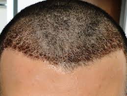 Should I Remove Scabs After Hair Transplant Surgery Hair Loss Q A Hair Transplant Hair Transplant Surgery Hair Implants