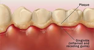 Use these amazing home remedies to remove plaque and tartar from your teeth. Plaque