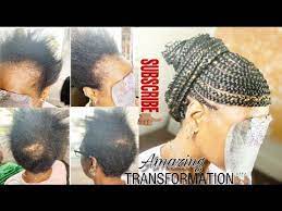 40 Alopecia Versatile Braid Style Amazing Transformation Youtube Braid Styles Amazing Transformations Alopecia