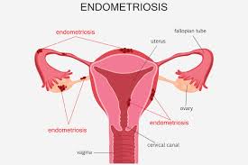 Can You Get Pregnant With Endometriosis