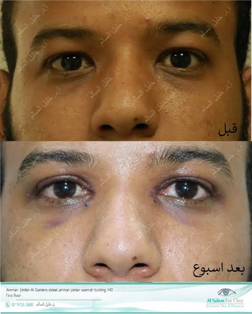 تجميل زوايا العين قبل وبعد، من إنشاء الذكاء الاصطناعي