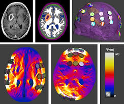 Recently, a manuscript by ceresoli et al. Novocure S Tumor Treating Fields Innovative Brain Cancer Therapy With Survival And Safety Benefits