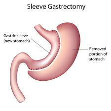 Dr Christian Birkedal Best Daytona Beach Hospitals Sleeve Gastrectomy Sleeve Surgery Vertical Sleeve Gastrectomy