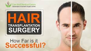 What is a hair graft. How Really Successful Is Hair Transplant Surgery Then Decide Blog Care Well Medical Centre