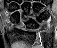 The most common cause is an abdominal aortic aneurysm that has ruptured spontaneously. Triangular Fibrocartilage Tear Radsource