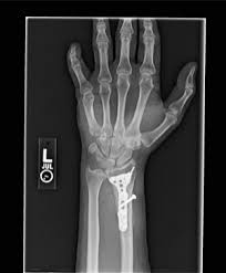 We'd also like to use analytics cookies. Wrist Fracture X Ray Broken Wrist Wrist Fracture Wrist Scar