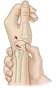Image result for Scaphoid Shift Test