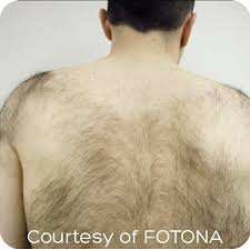 Perianal laser hair removal for men. Laser Hair Removal Treatment Kent Permanent Hair Removal Tunbridge Wells