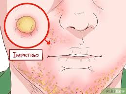 Staph infections—including those caused by mrsa—can spread in hospitals, other healthcare facilities, and in the community where you live, work, and go to school. Symptome Einer Mrsa Infektion Erkennen 13 Schritte Mit Bildern Wikihow