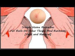 In most cases a boil that develop on the buttocks can be quite red, swollen and painful to the slightest touch. Simple Home Remedies For Boils On Inner Thighs And Buttocks Fast And Nat Home Remedy For Boils How To Get Rid Of Pimples Boils On Buttocks