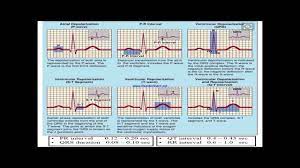 For example in case of angina. Normal And Abnormal Ecg Youtube