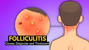 Image result for folliculitis symptoms