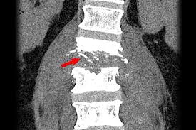 Image result for Spinal Infection