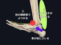 足首 捻挫 ふくらはぎ 痛い